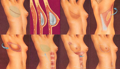 breast_reconstruction